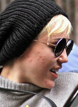 Miley-Cyrus-pimples